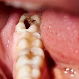 Aspirina pode regenerar dente após cárie, dizem cientistas
