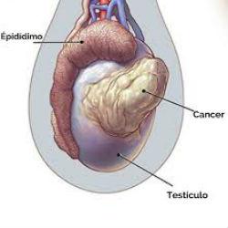 5 sintomas diferentes para câncer de testiculo