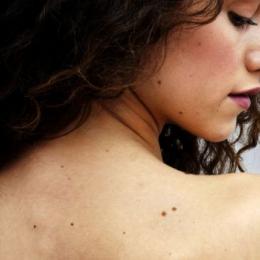 Como saber se as pintas na pele representam perigo para a saúde