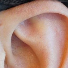 Seio pré-auricular: por que algumas pessoas têm um furinho na parte de cima da orelha?