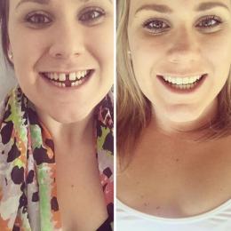 Confira 20 transformações incríveis de pessoas que tinham dentes fora do lugar
