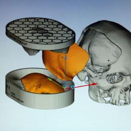 Brasileiros desenvolvem tecnologia de reconstrução craniana