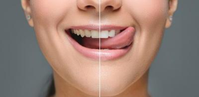 Entenda como remédios, genética e envelhecimento mudam a cor dos dentes
