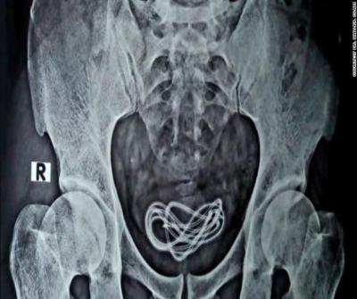 Homem passa por cirurgia após enfiar cabo de carregador de celular no próprio pênis