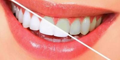 Use esses 5 remédios caseiros para clarear os dentes