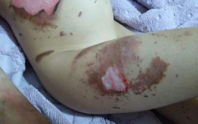 Celular explode e menina de 5 anos sofre queimaduras de 2º grau: 
