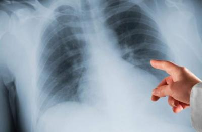 De mofo no pulmão a infecção no coração: quais sequelas a covid-19 pode deixar?