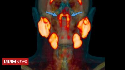 Cientistas dizem ter descoberto por acaso órgão misterioso no centro da cabeça humana
