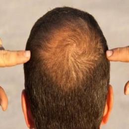 Causas da queda de cabelo: confira a lista e como prevenir