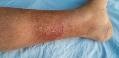 Lesão de continuidade na pele pode ser porta de entrada para bactérias