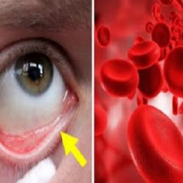  Você tem anemia? Conheça os principais sintomas!