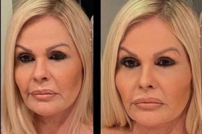 Monique Evans mostra antes e depois de harmonização facial: 'Sem filtro'