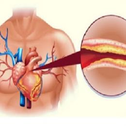  8 sintomas de colesterol alto que não podem ser ignorados