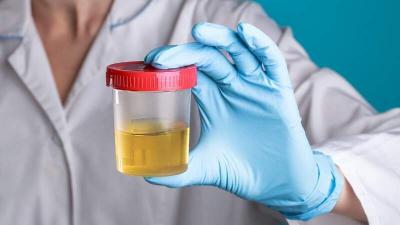 Exame de urina: o que é e como realizar o preparo