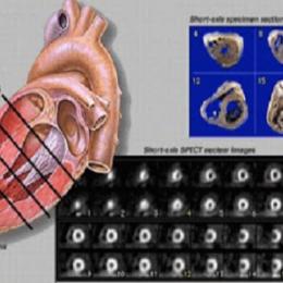  Cintilografia cardíaca - exame para doenças cardiovasculares