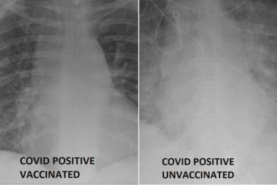 Raios X mostram diferença em casos de covid entre pacientes vacinados e não vacinados