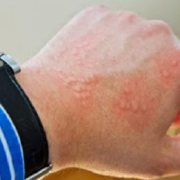  7 doenças que causam manchas vermelhas na pele