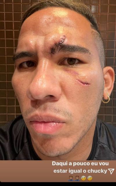 Jael mostra rosto atingido após lance contra Palmeiras: 