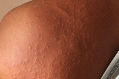 Passam de 200 casos de doença de pele misteriosa em Recife