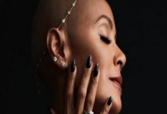 Alopecia: A condição que afeta Jada Pinkett Smith, espota de Will Smith
