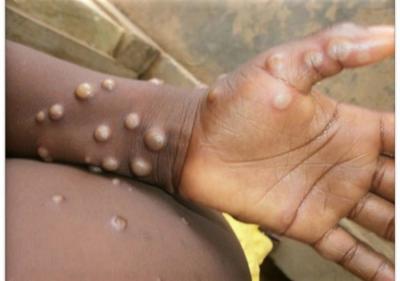 Vírus da varíola do macaco tem sequência de genoma mapeada
