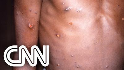 OMS registra mais de 130 casos da varíola dos macacos | NOVO DIA