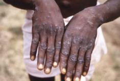 Cientistas africanos perplexos com casos de varíola na Europa e EUA