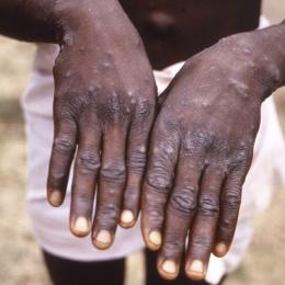 Cientistas africanos perplexos com casos de varíola na Europa e EUA