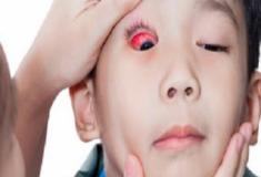 Tracoma - doença infecciosa que afeta a córnea