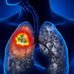 Estudo indica para SUS radioterapia que trata câncer de pulmão em até 5 sessões