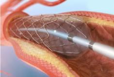  Angioplastia - procedimento cirúrgico para desobstruir artérias