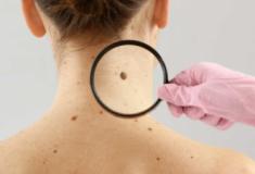 Tecnologia para tratar câncer de pele é aprovado para uso no SUS