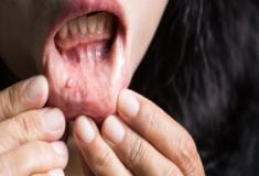 Câncer de boca: saiba como detectar a doença precocemente