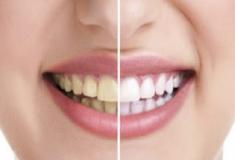  Mitos e verdades sobre o clareamento artificial dos dentes