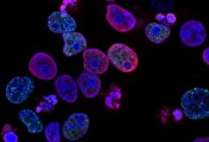 Microplásticos podem se acumular nas células cancerígenas e podem ajudá-las a se espalhar