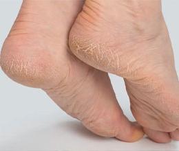 O que causa rachaduras nos pés e como tratar?