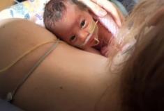 Bebê nasce com órgãos expostos e sobrevive com auxilio de filme PVC