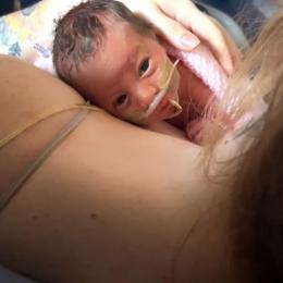 Bebê nasce com órgãos expostos e sobrevive com auxilio de filme PVC