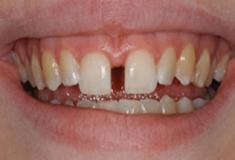  Diastema - afastamento entre os dentes centrais