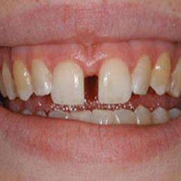  Diastema - afastamento entre os dentes centrais