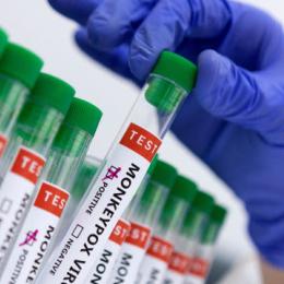 Mpox aumenta mo Brasil e reacende alerta para monitoramento e vigilância