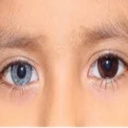 Heterocromia - pessoas e animais com olhos de cores diferentes