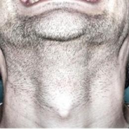 Por que os homens têm pomo de Adão?