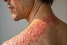 Herpes zoster - como identificar e tratar