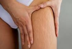 10 dicas para eliminar as estrias naturalmente