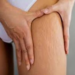 10 dicas para eliminar as estrias naturalmente