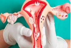 Endometriose - entenda seus sintomas e o tratamento