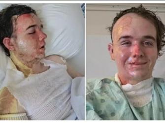 Jovem fica em estado grave após colega jogar óleo fervente durante expediente de trabalho