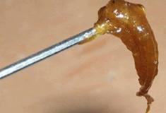 Como remover a cera de ouvido corretamente?