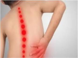 Nódulo de Schmorl - fraqueza da placa vertebral